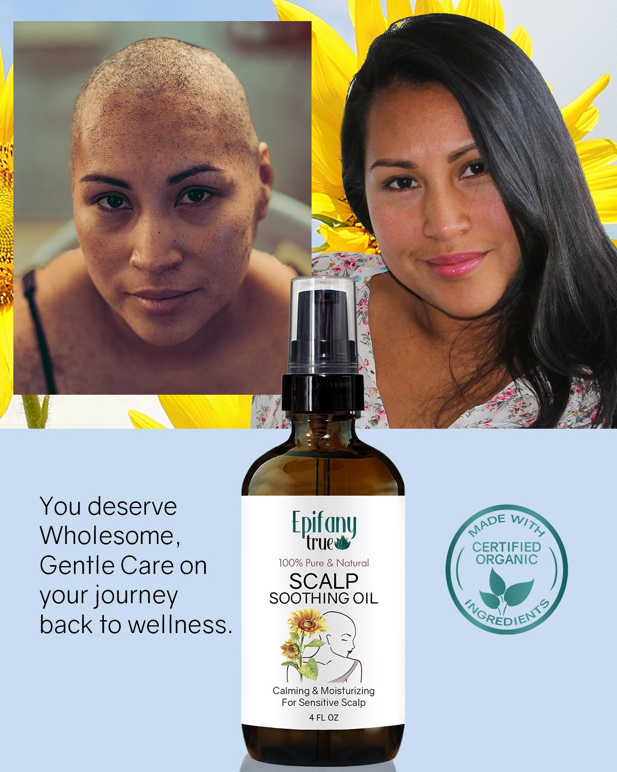 Epifany True 100% Pure & Natural Scalp Soothing Oil 4oz for tender dry itchy chemo scalp with cancer patient